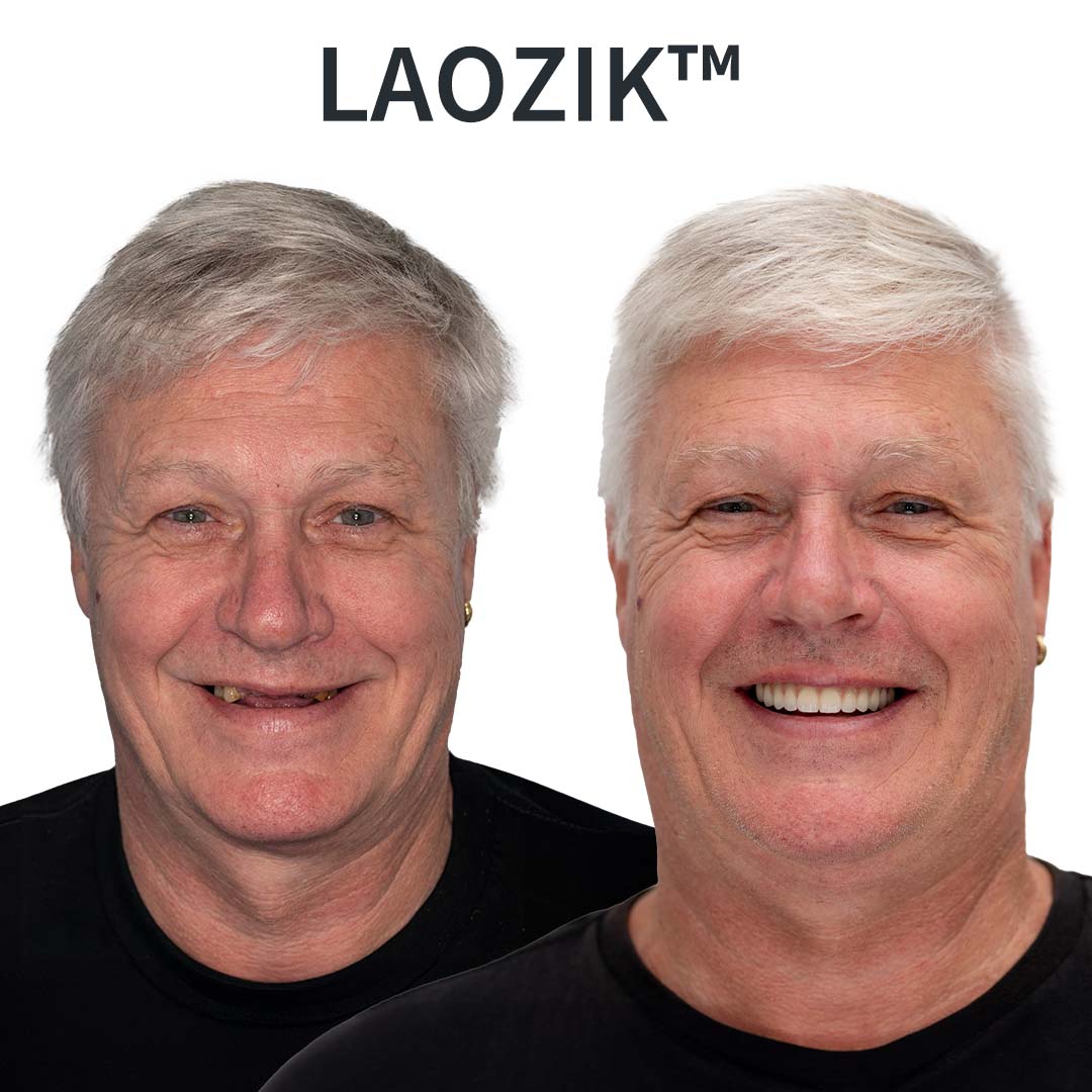 LAOZIK™ prilagodljive funkcionalne proteze – izdelane v ZDA in certificirane s strani FDA