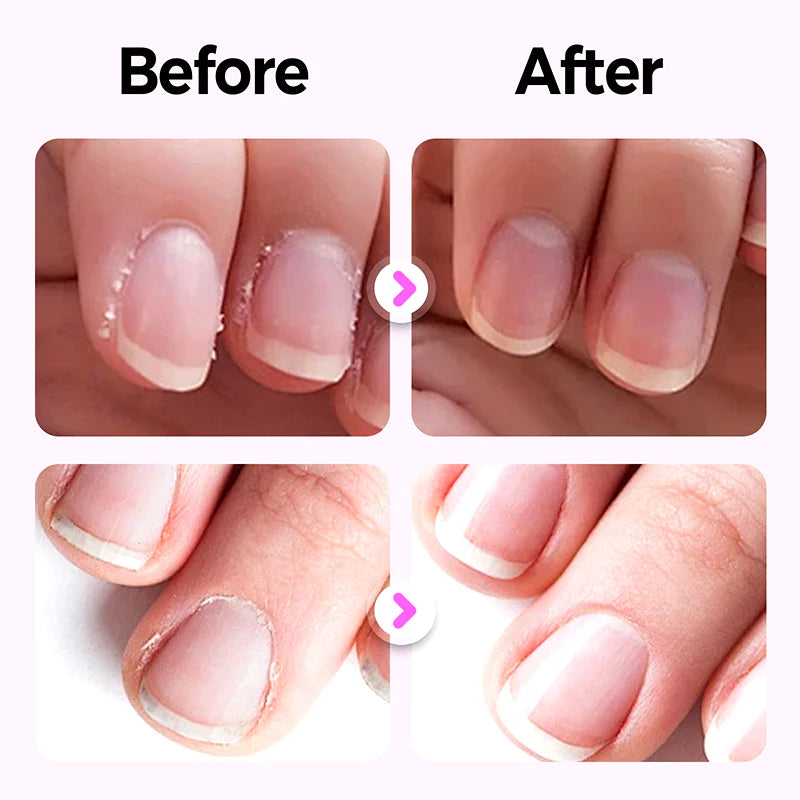 💅Olovka za njegu noktiju tri u jednom, protiv peckanja, njega rubova noktiju