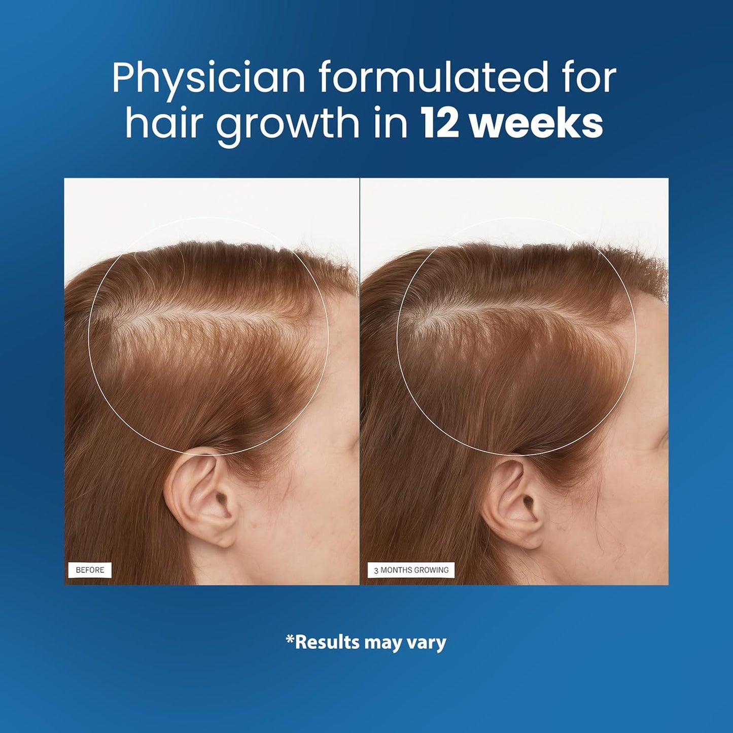 (❗Omogoča vam goste lase🔥) Serum za lase【🔥Kupite 1, dobite 1 gratis】